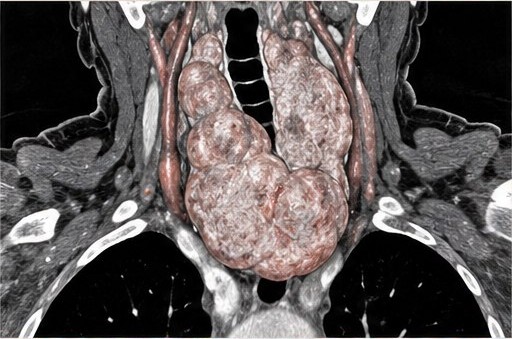CT image illustrating a large thyroid goiter and its extent into the chest